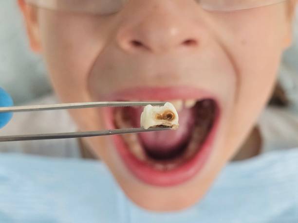 Best Chipped Tooth Repair Near Me  in Bowling Green, KY